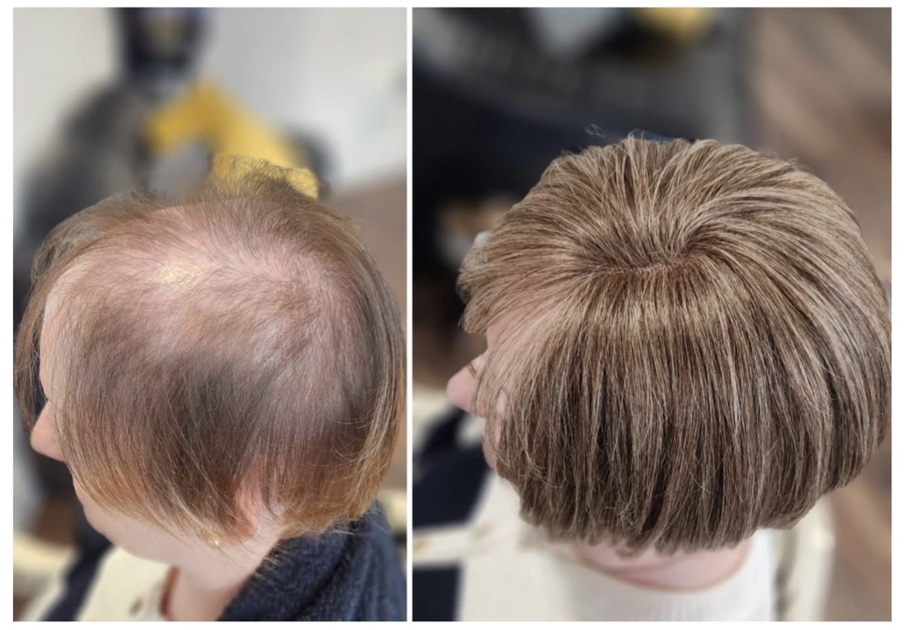 Genuine iHobbs client transformation shown before and after non surgical hair replacement